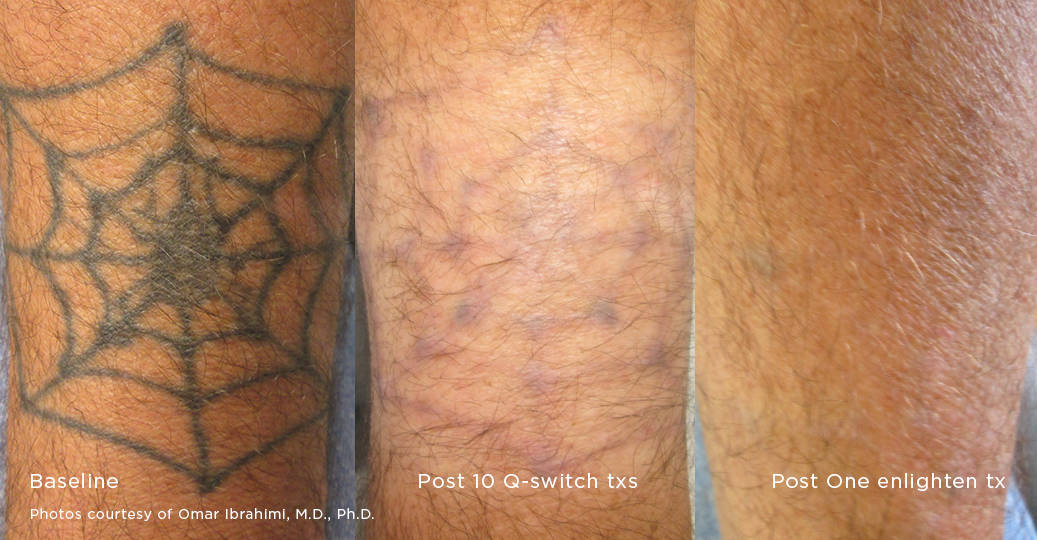 Spider web tattoo on arm before during after remove