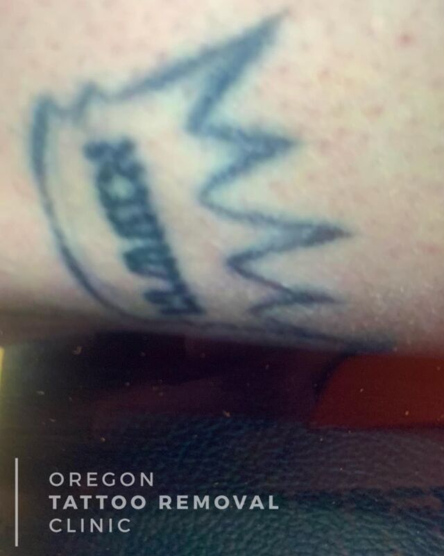 Tattoo Removal  TAKE IT OFF TATTOO REMOVAL  ALT SPA  23 Photos  1007 E  Burnside St Portland Oregon  Phone Number  Yelp