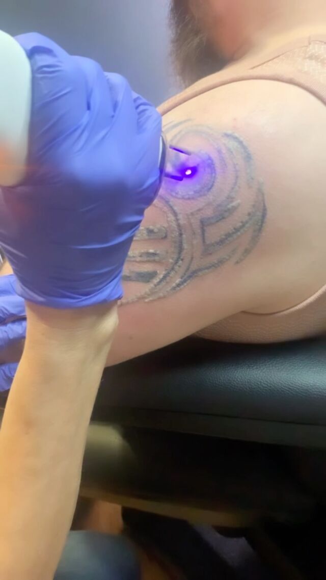 Laser Tattoo Removal at Take It Off  Pink Panther Tattoo PDX