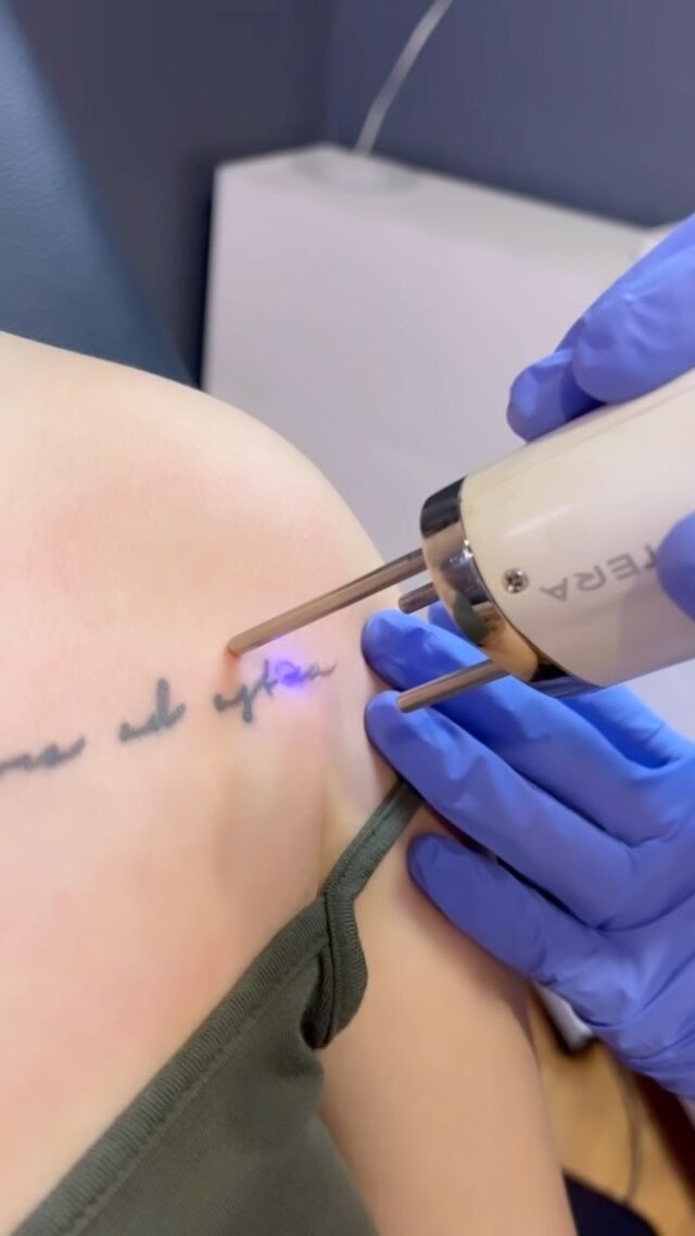 Saline Tattoo Removal  NonLaser Tattoo Removal in Portland
